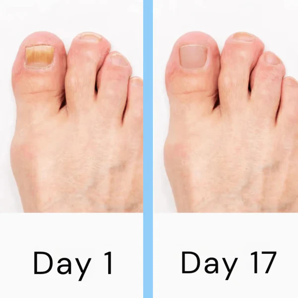 BowLift | Nail Laser Fungus Device