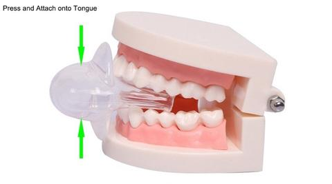 BowLift | Apnea Tongue Stabilizing Device