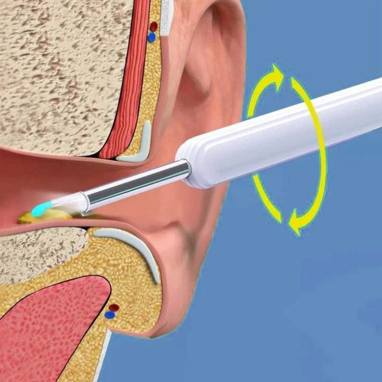 BowLift | EarScope Pro Ear Wax Removal Kit | High-Resolution Camera & LED Lights for Safe Home Use