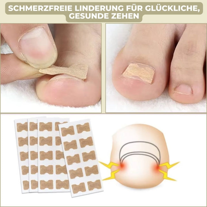 BowLift | ALIGNSTRIP – Painless Nail Correction Strips for Ingrown & Deformed Nails