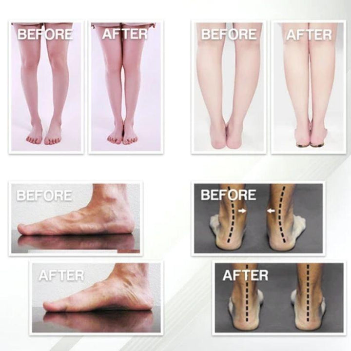 BowLift | Flat Foot Orthopedic Insoles