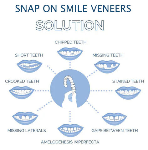 BowLift | Smile Veneer (Upper & Lower Included)