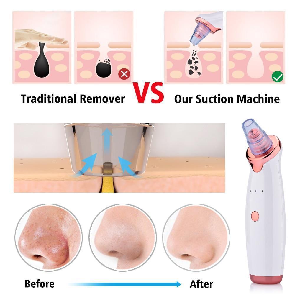 BowLift | Power Suction Blackhead Cleaner